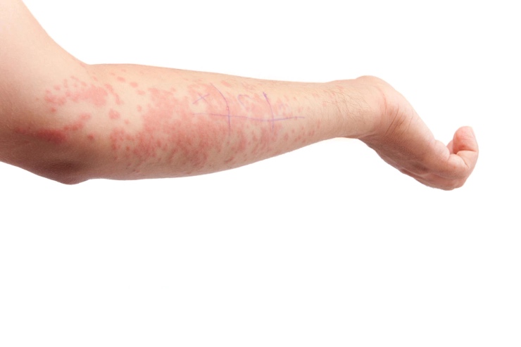 Orticaria cronica